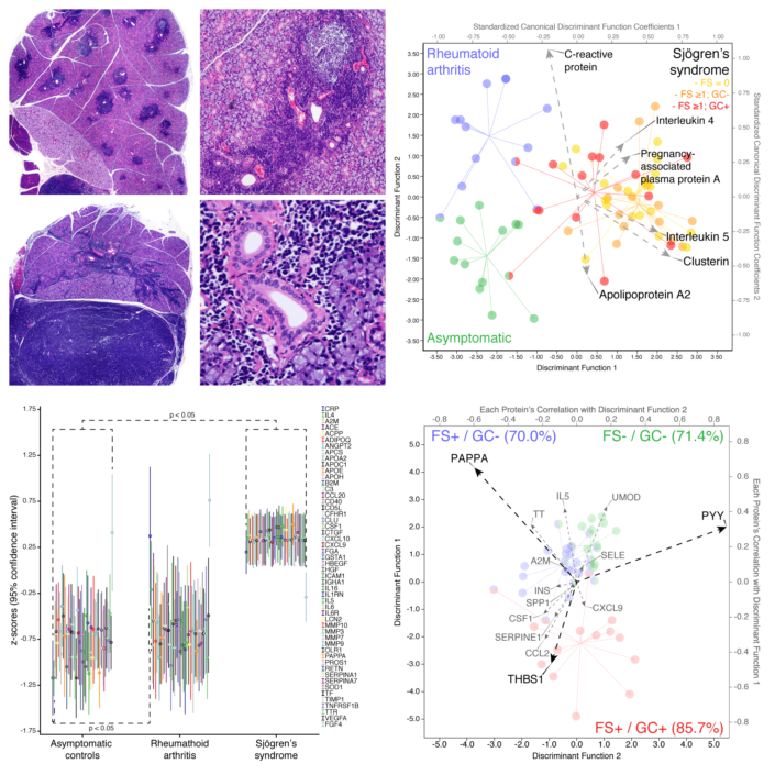 Biomarker-based patient stratification Substituting invasive biopsy-based procedures for Sjögren’s syndrome-patient diagnosis and stratification for cancer-risk with proteomics-biomarker signatures obtained from saliva.